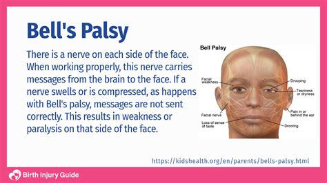 bell's palsy paediatric nice cks